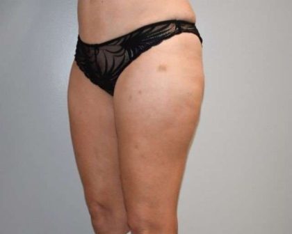Liposuction Before & After Patient #448