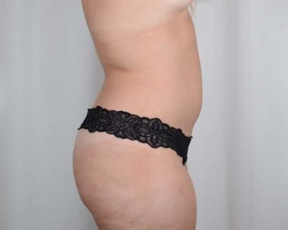 Liposuction Before & After Patient #453