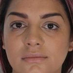 Liposuction Before & After Patient #458