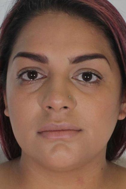 Liposuction Before & After Patient #458
