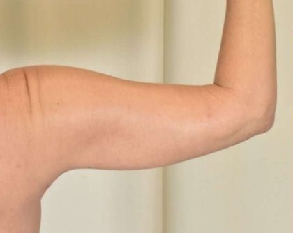 Liposuction Before & After Patient #473
