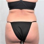 Liposuction Before & After Patient #480
