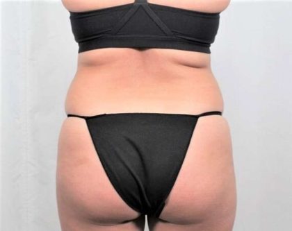 Liposuction Before & After Patient #480