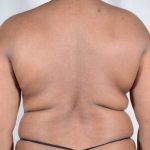 Liposuction Before & After Patient #483