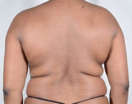 Liposuction Before & After Patient #483