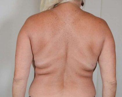 Liposuction Before & After Patient #486