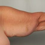 Arm Lift Before & After Patient #501