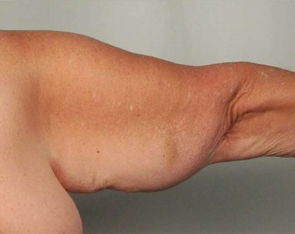 Arm Lift Before & After Patient #501