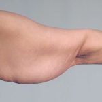 Arm Lift Before & After Patient #506