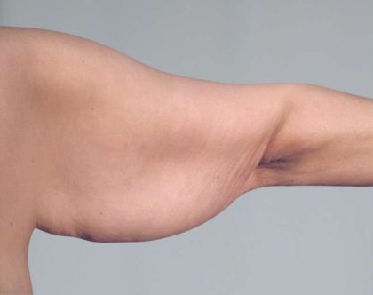 Arm Lift Before & After Patient #506