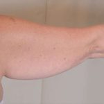 Arm Lift Before & After Patient #511
