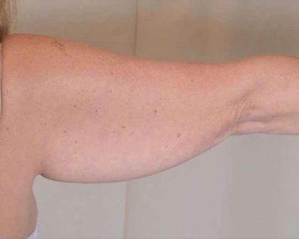 Arm Lift Before & After Patient #511