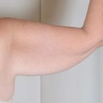 Arm Lift Before & After Patient #516