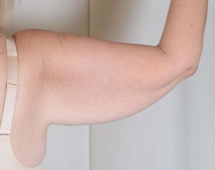 Arm Lift Before & After Patient #516