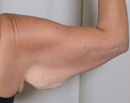 Arm Lift Before & After Patient #521