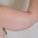 Arm Lift Before & After Patient #526