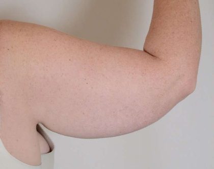 Arm Lift Before & After Patient #526