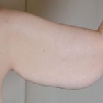 Arm Lift Before & After Patient #531