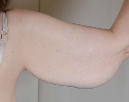 Arm Lift Before & After Patient #531