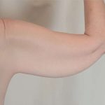 Arm Lift Before & After Patient #536