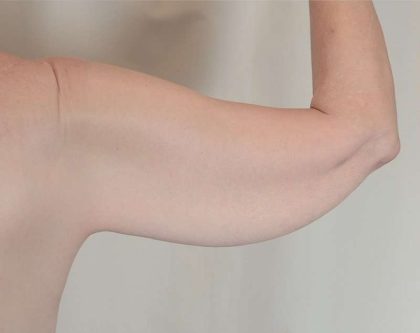 Arm Lift Before & After Patient #536