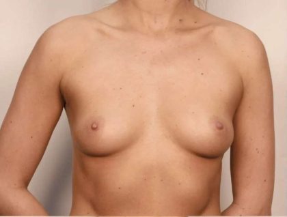Breast Augmentation Before & After Patient #606