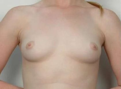 Breast Augmentation Before & After Patient #611