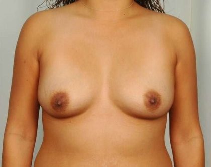 Breast Augmentation Before & After Patient #616