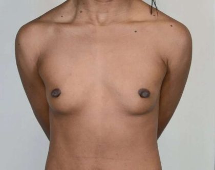 Breast Augmentation Before & After Patient #661