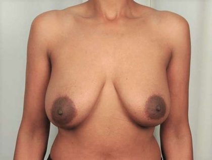 Breast Lift Before & After Patient #741