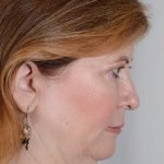 Facelift Before & After Patient #913