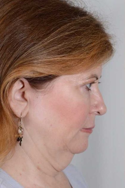 Facelift Before & After Patient #913
