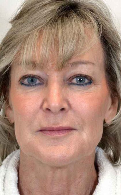 Facelift Before & After Patient #918