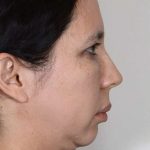 Facelift Before & After Patient #923