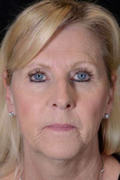 Facelift Before & After Patient #928