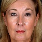 Facelift Before & After Patient #933
