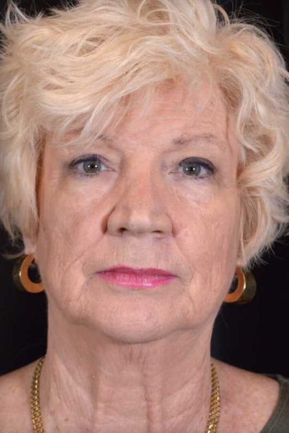 Facelift Before & After Patient #938
