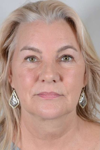 Facelift Before & After Patient #948
