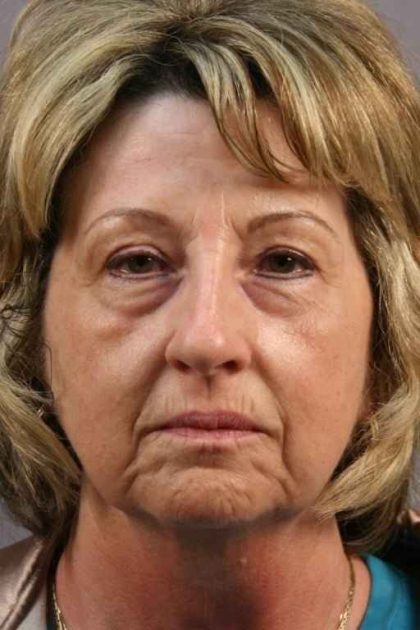 Facelift Before & After Patient #953