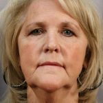 Facelift Before & After Patient #958