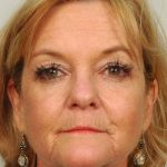 Facelift Before & After Patient #968