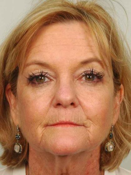 Facelift Before & After Patient #968