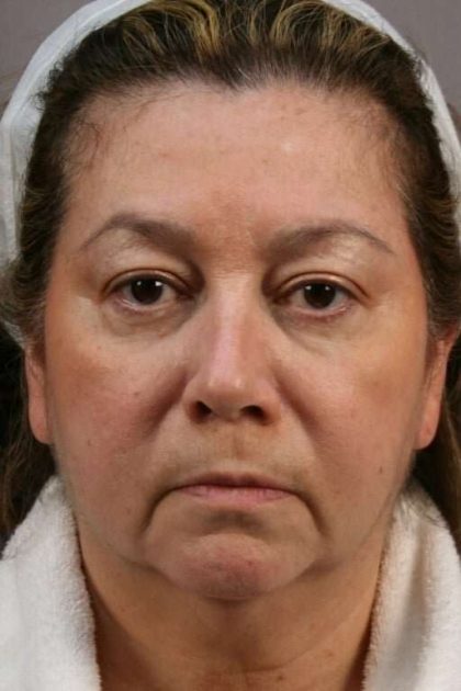 Facelift Before & After Patient #973