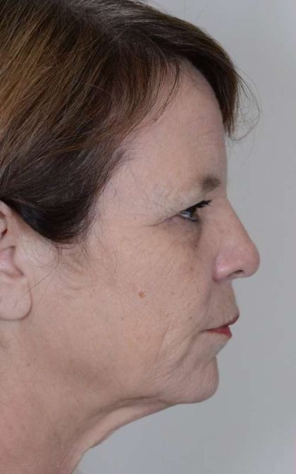 Facelift Before & After Patient #983