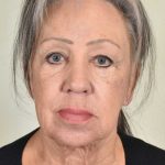 Facelift Before & After Patient #988