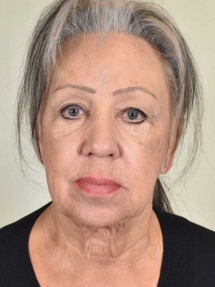 Facelift Before & After Patient #988