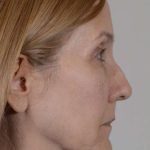 Facelift Before & After Patient #993