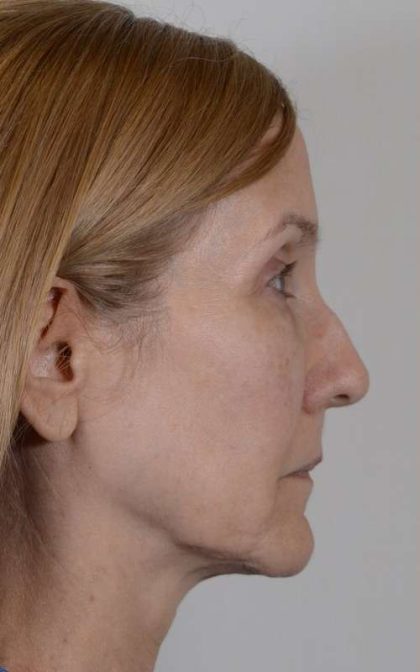 Facelift Before & After Patient #993