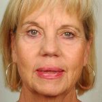 Facelift Before & After Patient #998