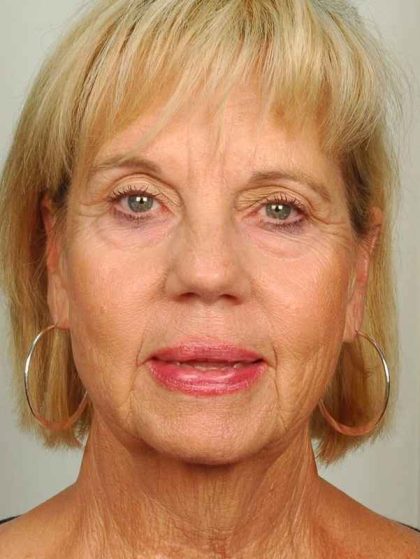 Facelift Before & After Patient #998